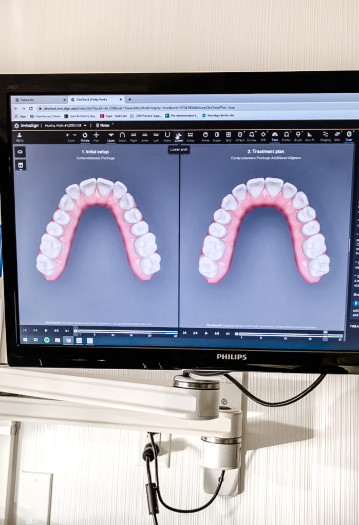 Dr Frank Neves St Albert Dentist Bright Dental St Albert Invisalign results