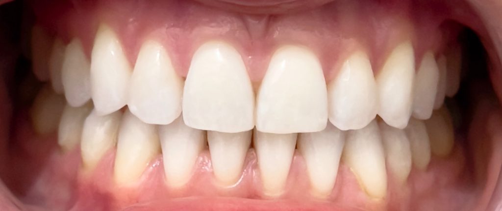 Closeup of Invisalign results at Bright Dental St Albert